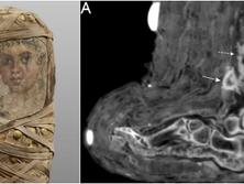 古代の医学が垣間見える...4歳の少女のミイラから、傷を覆った包帯を発見