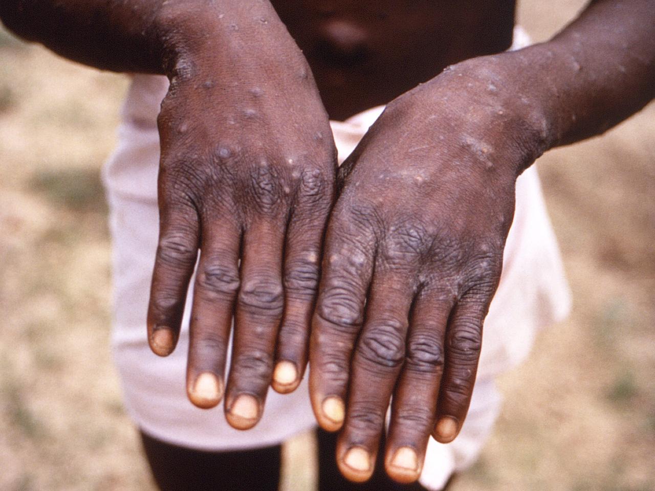A person with monkeypox in the Democratic Republic of the Congo holds out their hands, which are covered in lesions.