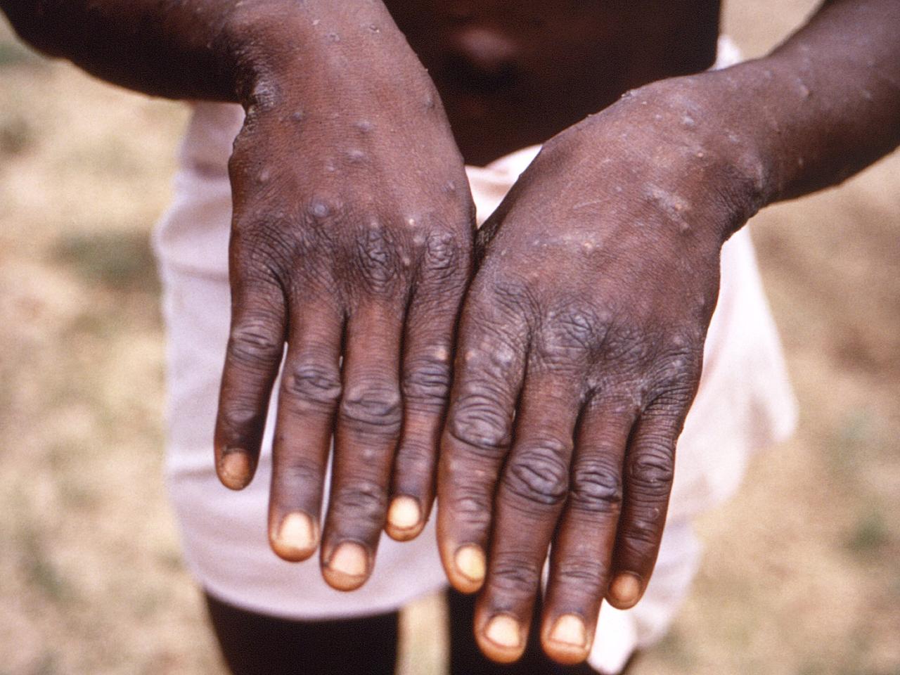 サル痘にかかった人の病変に覆われた両手。コンゴ民主共和国で。