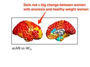 A model comparing cortical thickness in women with anorexia and women of a healthy weight. The darker areas are those with the starkest contrast, i.e. the most reduced cortical thickness in the women with anorexia.
