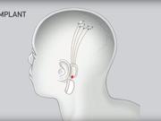 装置は耳のうしろに位置し、電極が糸で脳に埋めこまれる。