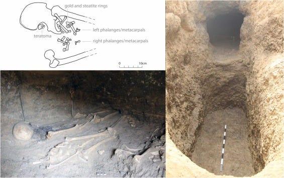 古代エジプト人は病とどう向き合っていたのか…3000年前の遺骨から奇形