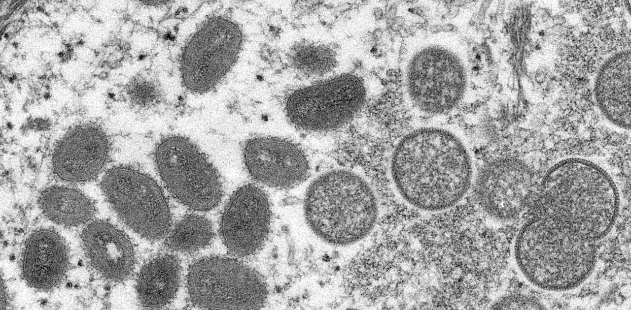 エムポックス（サル痘）との戦いはまだ続いている…コンゴ民主共和国で新型ウイルスによる流行が発生 | Business Insider Japan