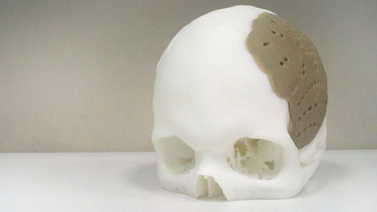 頭蓋骨の75%を3Dプリントの骨に移植した男ついに現る