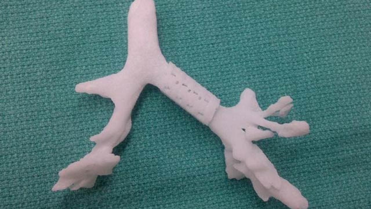 最新医療の現場、3Dプリントした人工パーツを体内に埋め込むことで呼吸ができるようになった少年
