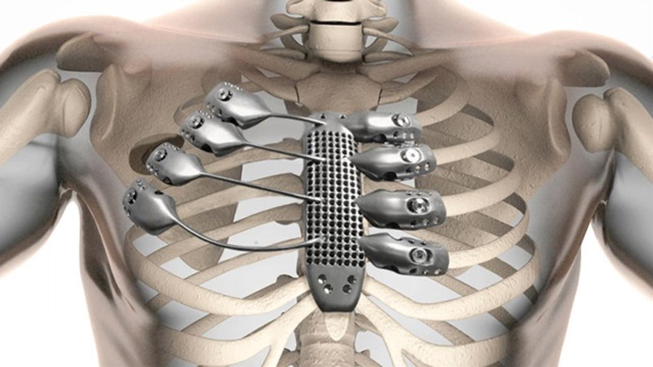 義体化きた 世界初3dプリントのチタン胸郭移植に成功 ギズモード ジャパン