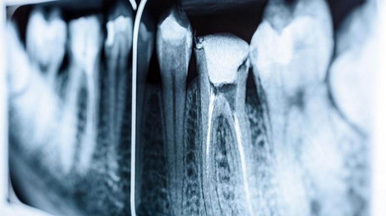 さらば根管治療？ 歯の自己修復を助ける素材が開発される