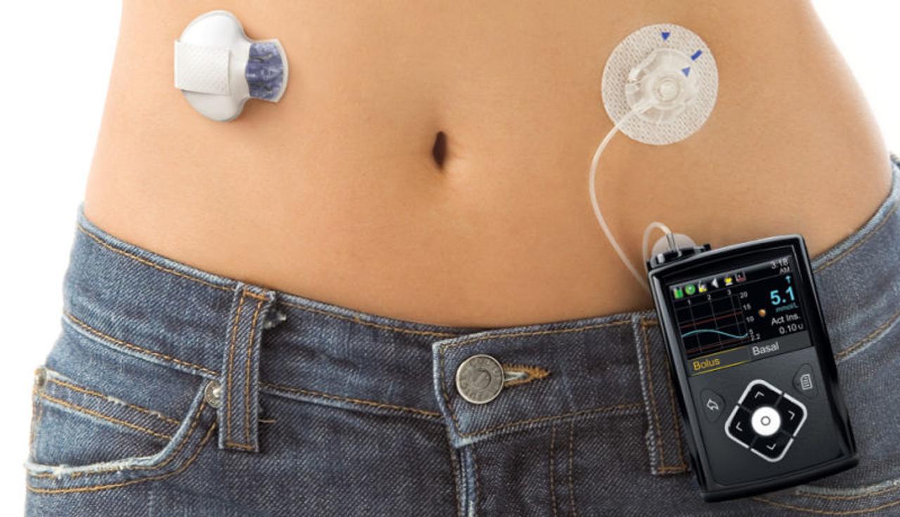 糖尿病患者に朗報か。自動的にインスリンを注入してくれるデバイス