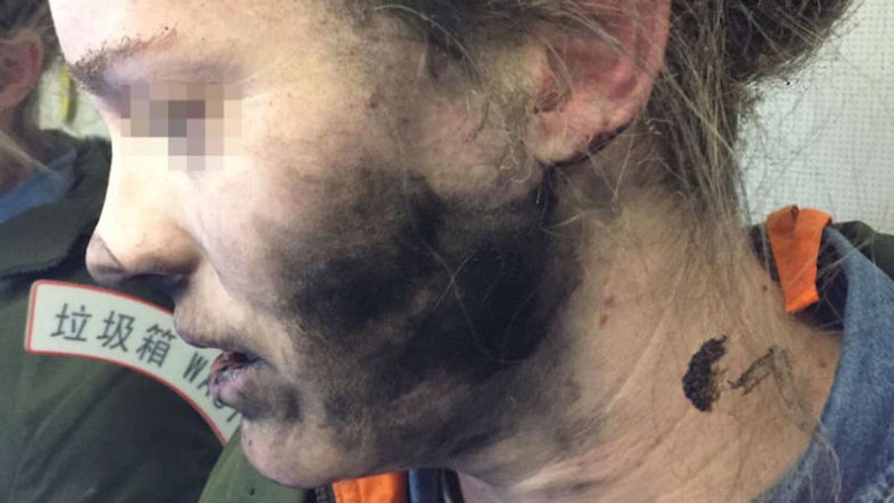 今度は機内でヘッドホンが爆発…女性のすす汚れが痛々しい