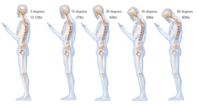 150622smartphone_occipital_nerve_a