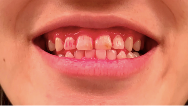 191105OralBGeniusX5