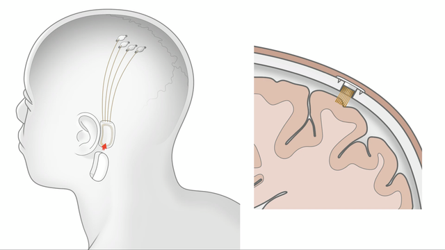 heusc-neuralink-implant