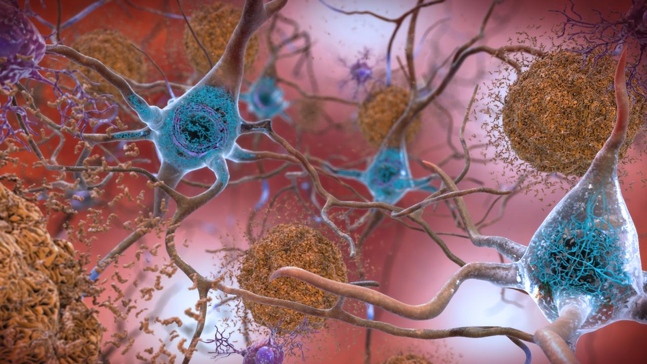アルツハイマー病患者の脳内から、異常な形の鉄と銅が発見される