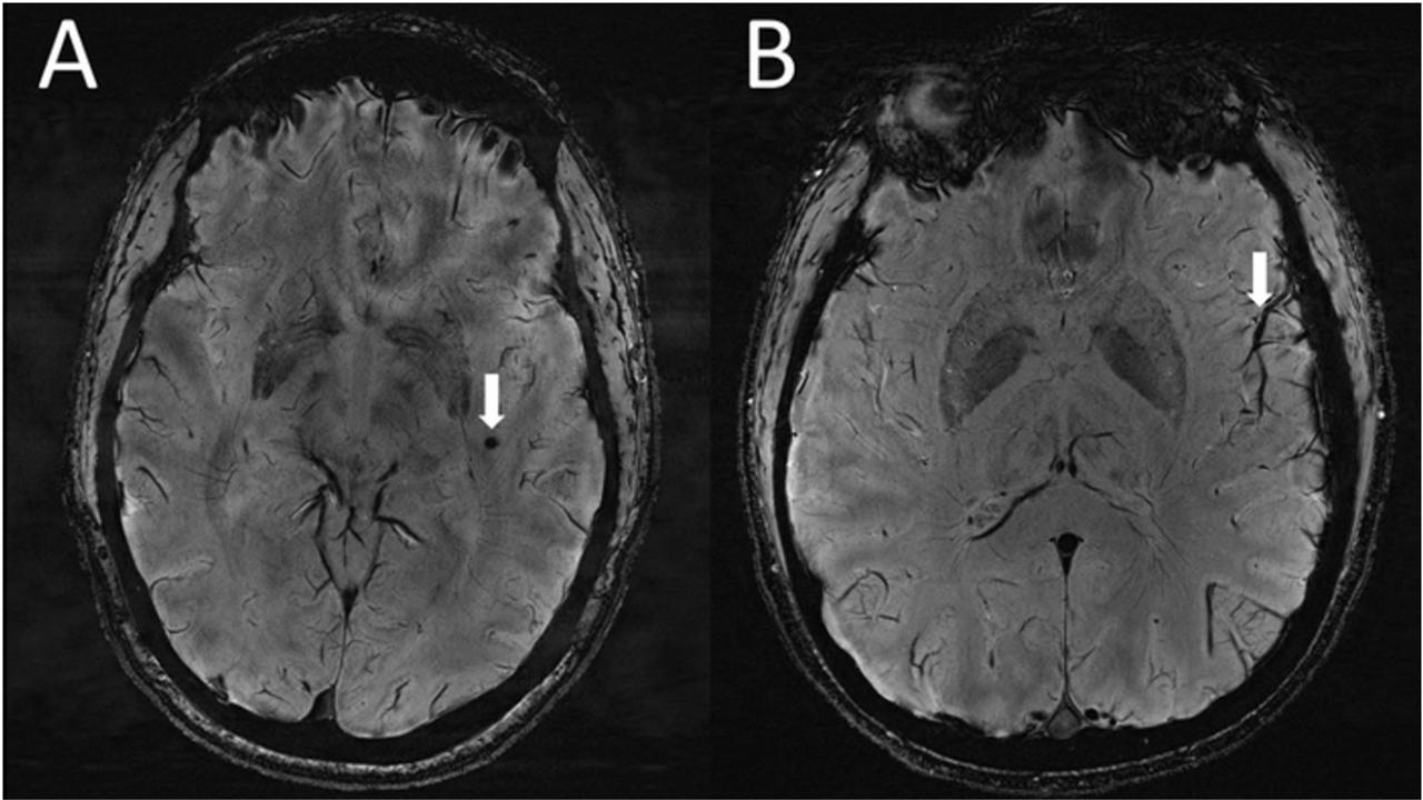 頭痛 MRI 何がわかる？