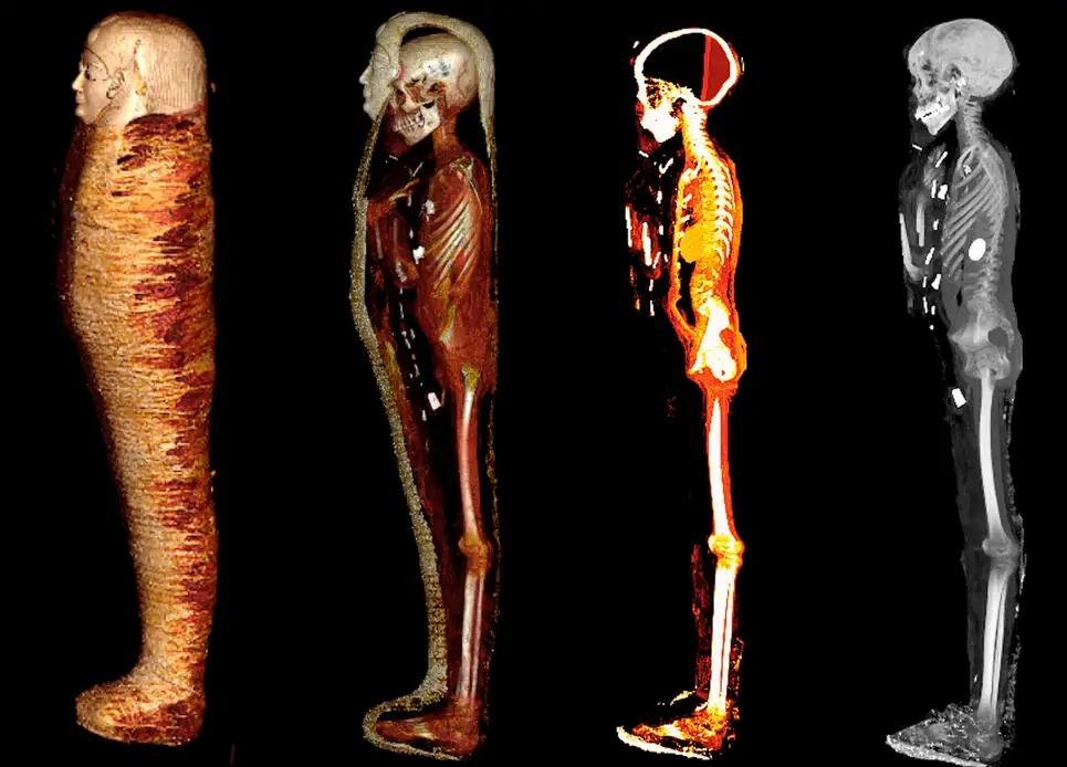 少年ミイラの秘密がCTスキャンで明かされる。おそらく富裕層です（1000