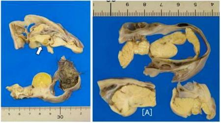 少女の卵巣から小さな脳と頭蓋骨の一部、髪の毛が発見される