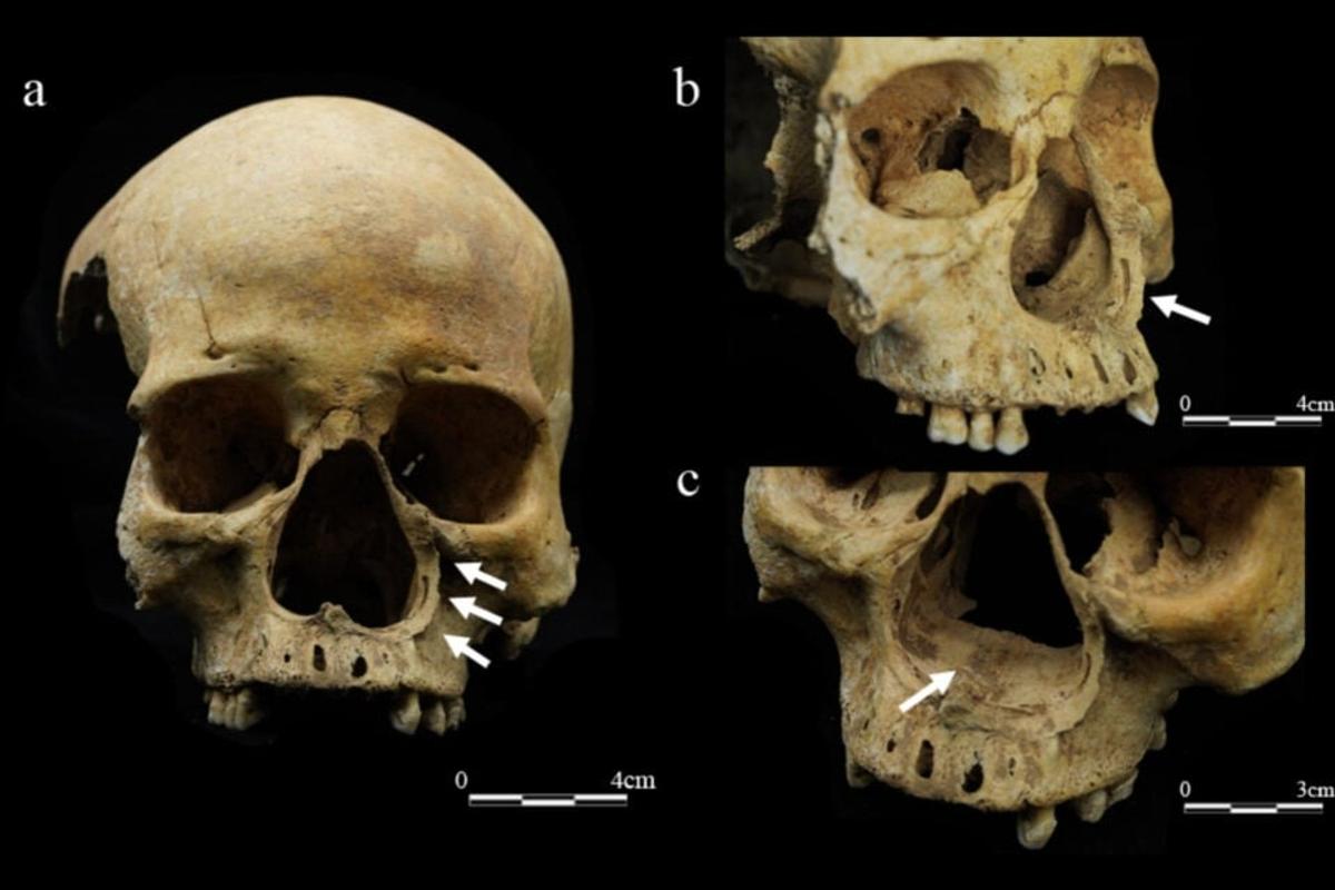 古代中国の文献にしかない「幻の刑罰」、人骨から初の証拠？