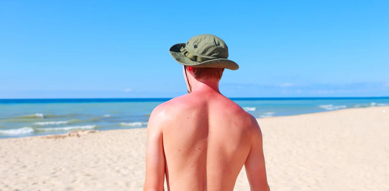 痛いほど日焼けしたときの対処 ケア方法5選 ライフハッカー 日本版